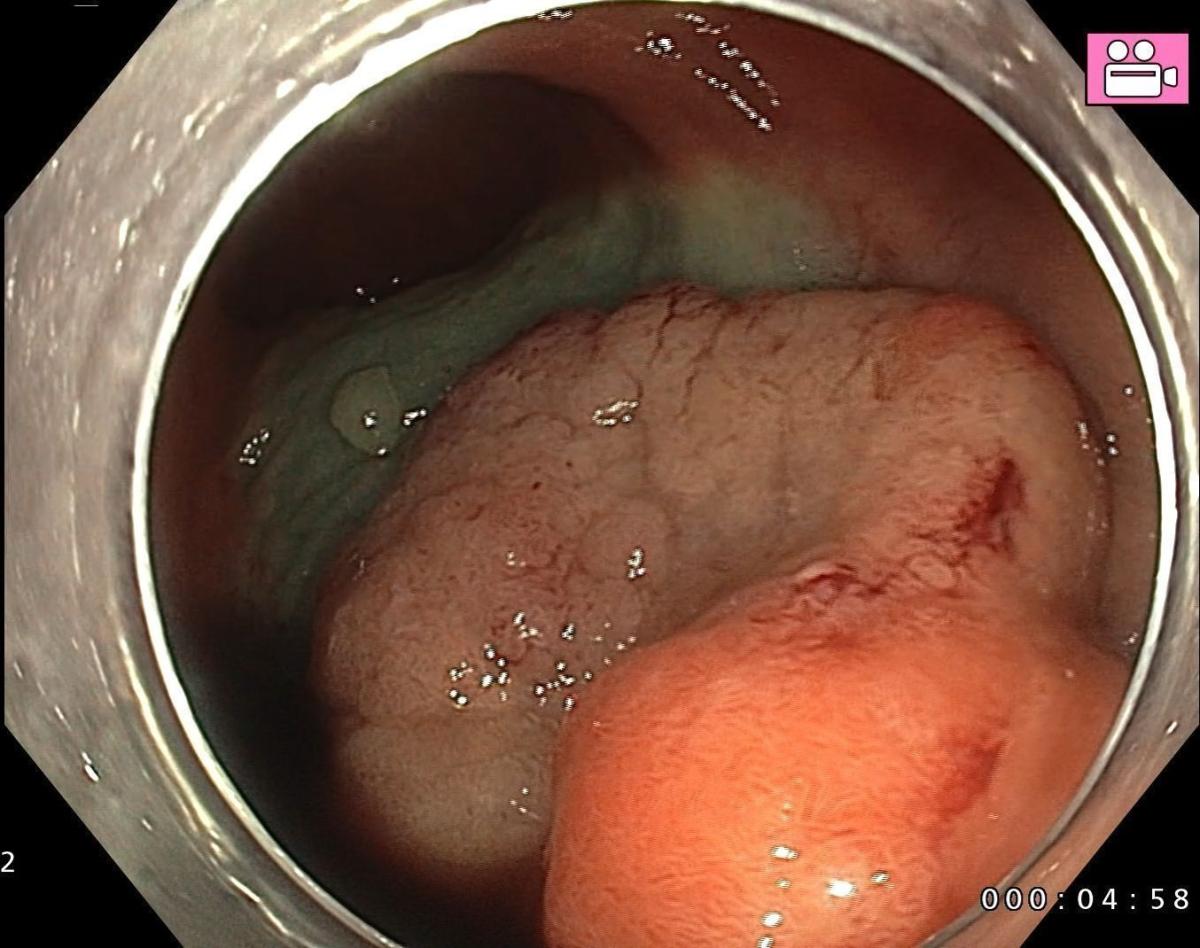 Initial submucosal injection proximally