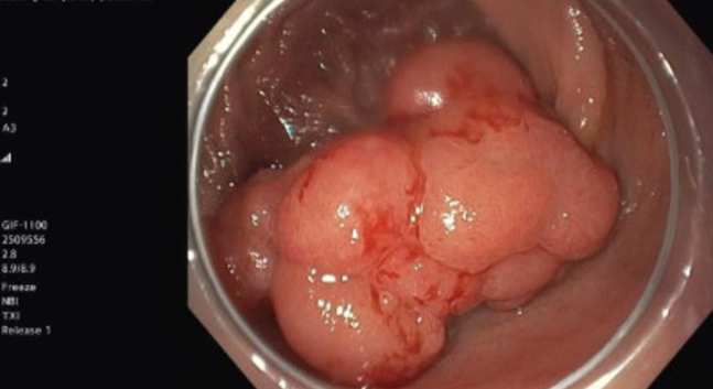 Lobulated Polyp