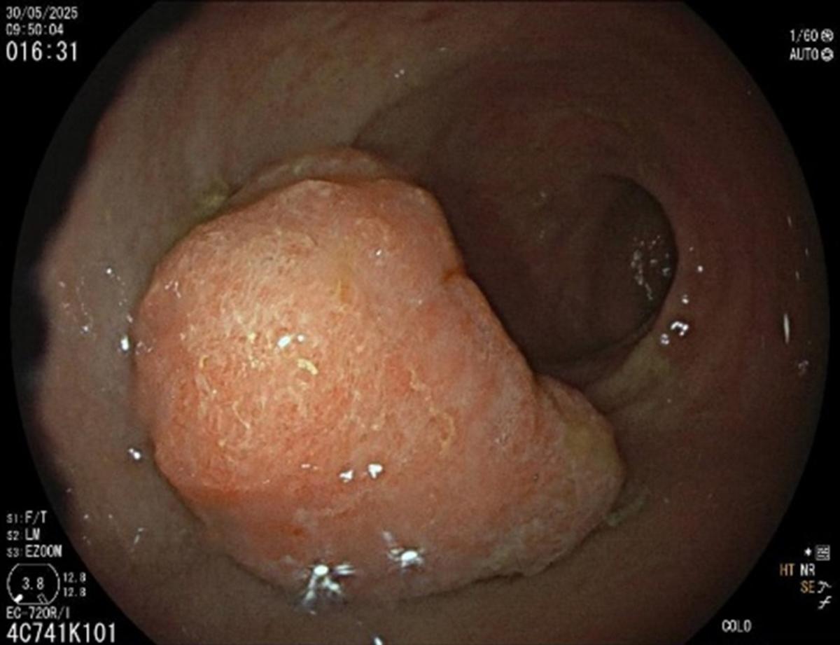 Rectal polyp paris lls