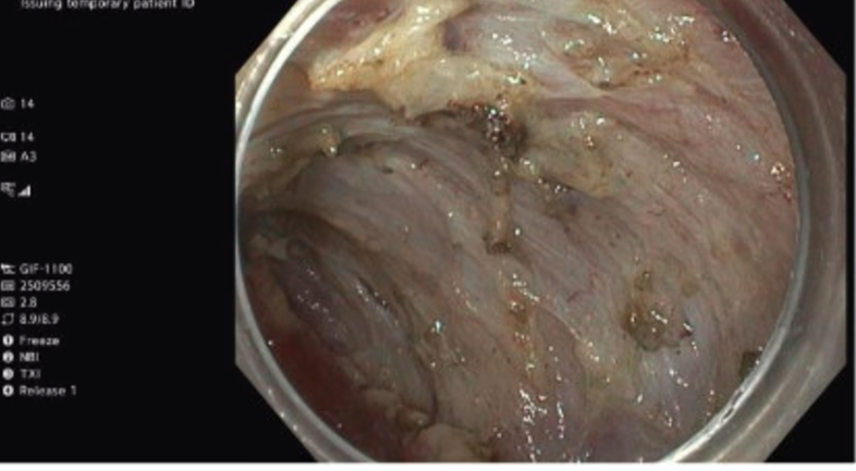 Resection down to the muscle layer