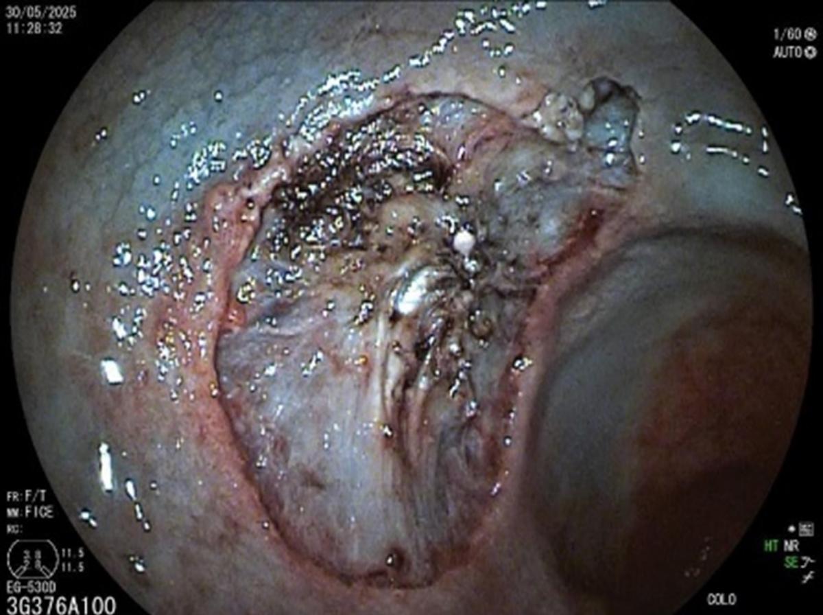 Resection plane