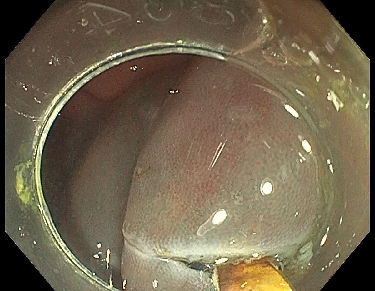Mucosa