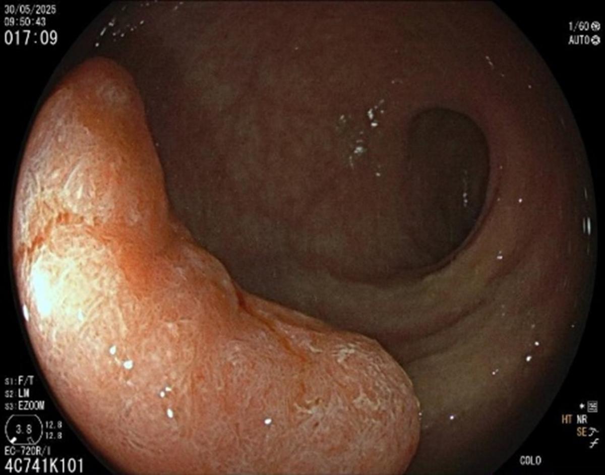 Polyp surface JNET 2b